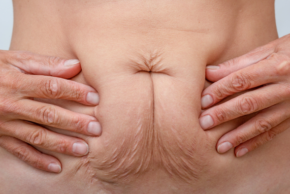 Cirurgia plástica após perda de peso