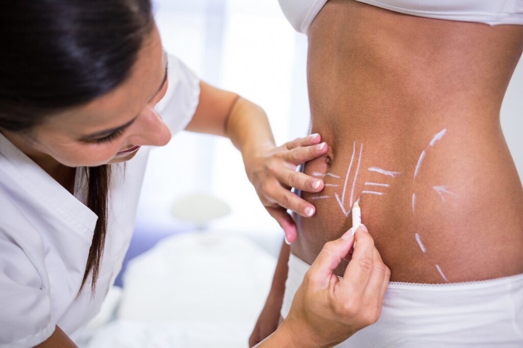 Lipoaspiração: tudo o que você precisa saber!