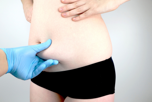 cirurgia de abdominoplastia