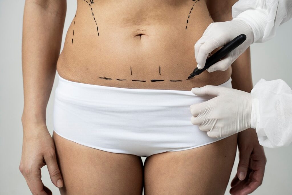Lipoabdominoplastia com dreno: quais as vantagens?
