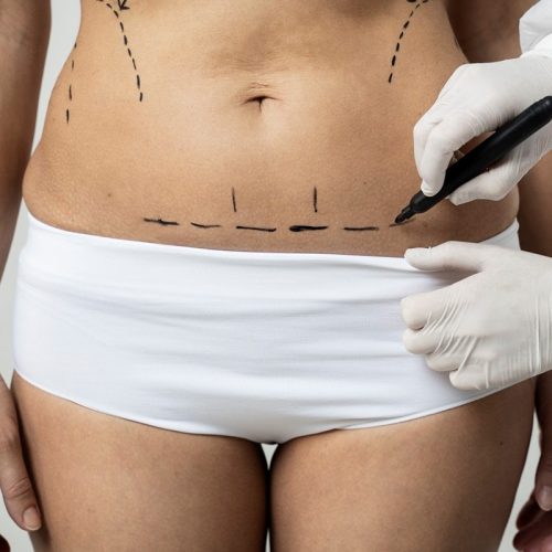 Lipoabdominoplastia com dreno quais as vantagens Lipoabdominoplastia com dreno: quais as vantagens?