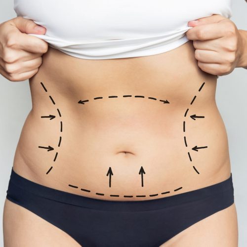 Lipoabdominoplastia sem Dreno: Conforto Pós-Operatório Mulher com barriga marcada